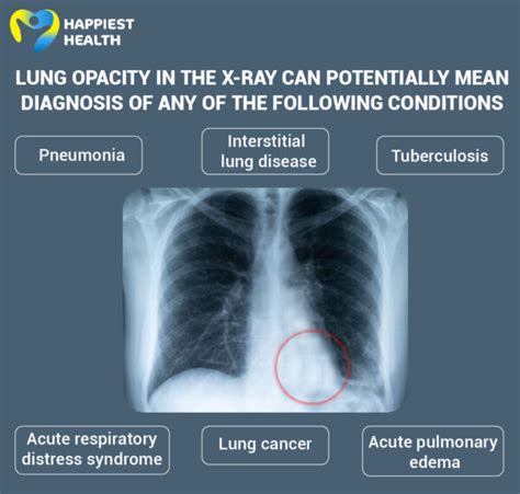 Lung Opacity: Understanding What This Means .